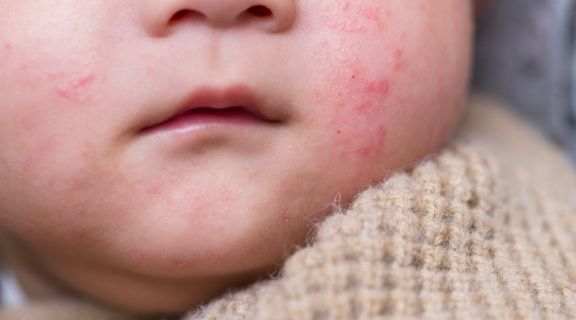 Bebê com alergia alimentar